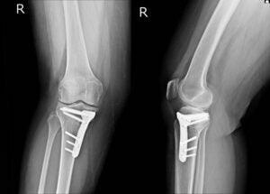 Common Leg Injuries From Car Accidents