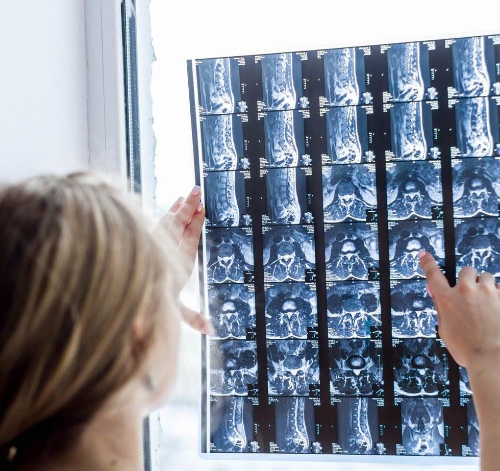 Spine Injury from a Car Accident: What You Need to Know